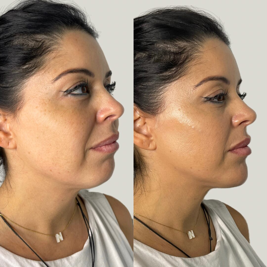 Armonización facial ( Full face )