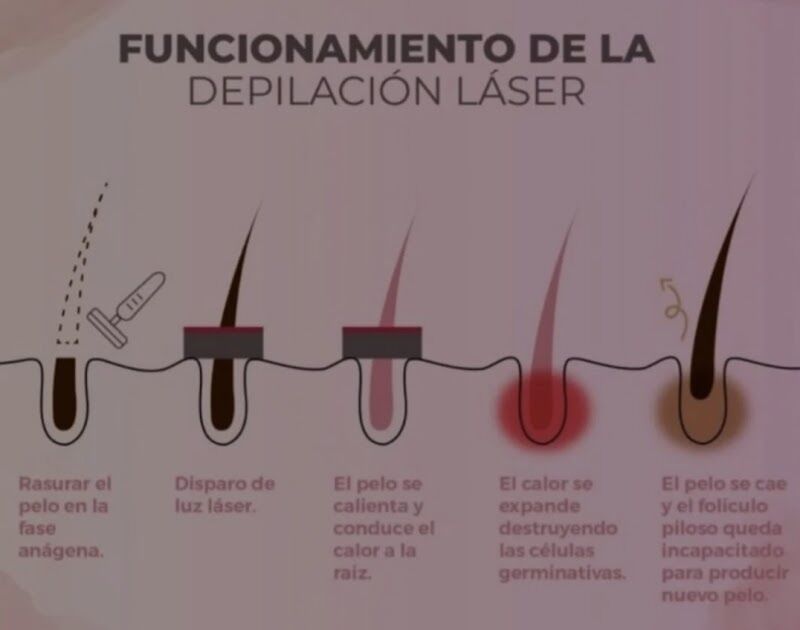 Imagen de Láser de Diodo Pro Toñi Rodríguez